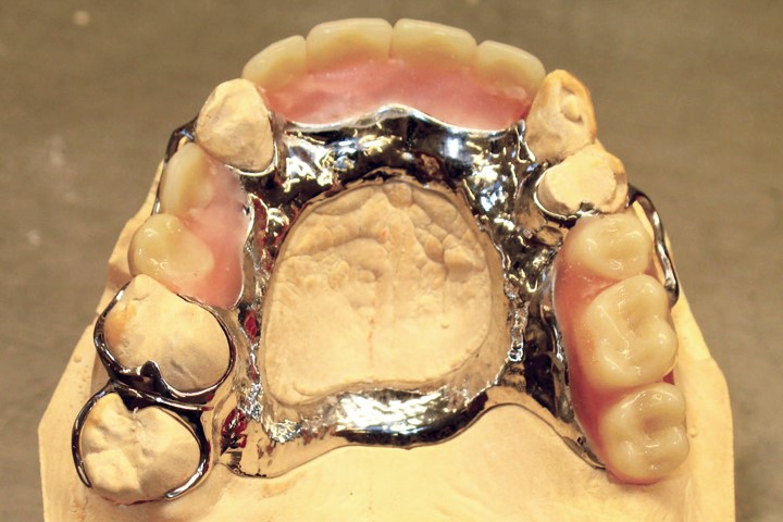 New Dentures Before And After Pictures Arlington TX 76096